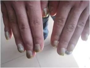 讨厌的灰指甲，还我美丽小脚丫！