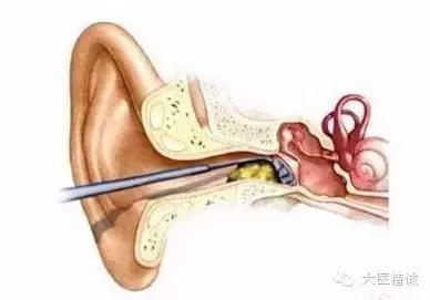 游泳耳朵进水了怎么办啊,游泳如何防止耳朵进水