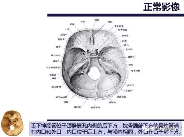 舌下神经和舌咽神经的解剖图,颊神经舌神经解剖图
