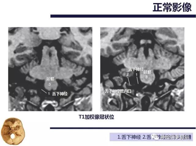 舌下神经和舌咽神经的解剖图,颊神经舌神经解剖图