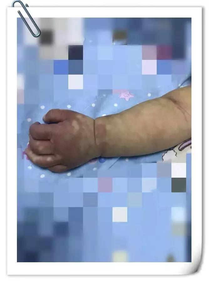 手背上有花斑的图片,手背上有褐色花斑是怎么回事