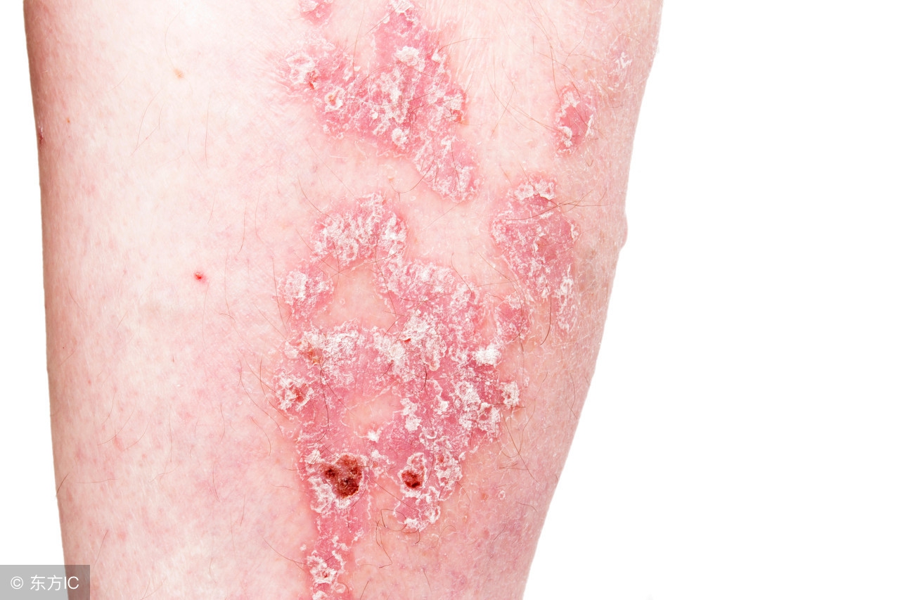 幼儿尖锐湿疣的症状有哪些呢