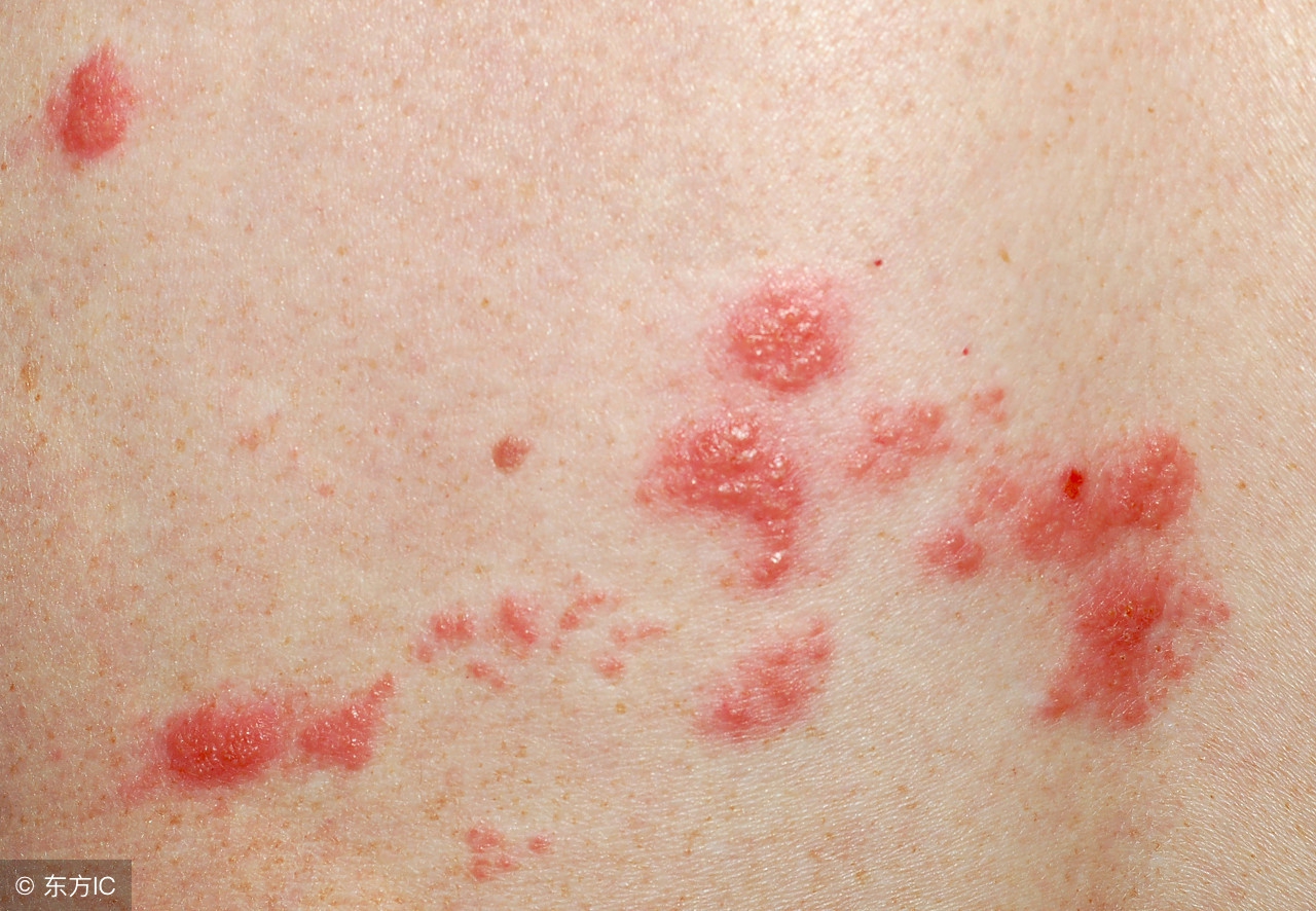 带状疱疹治疗方法和注意事项,带状疱疹治疗方法与注意事项