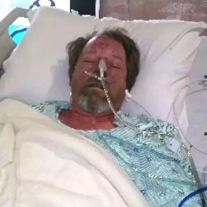 又一例！他严重感染四肢被截，竟只因被狗狗舔了一下……