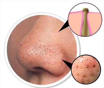 螨虫进入了体内如何清除,螨虫用什么方法可以取出来