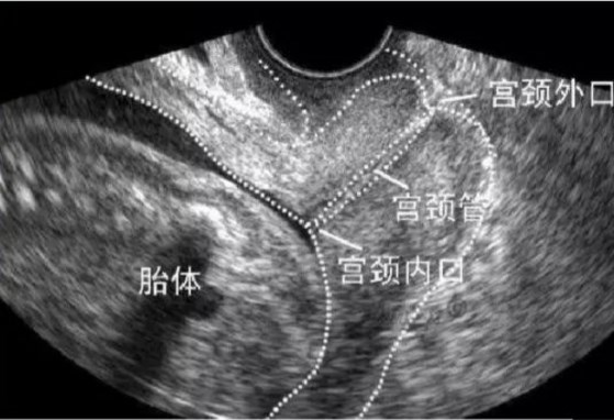 宫颈机能不全是不是容易痛,宫颈机能不全好治吗