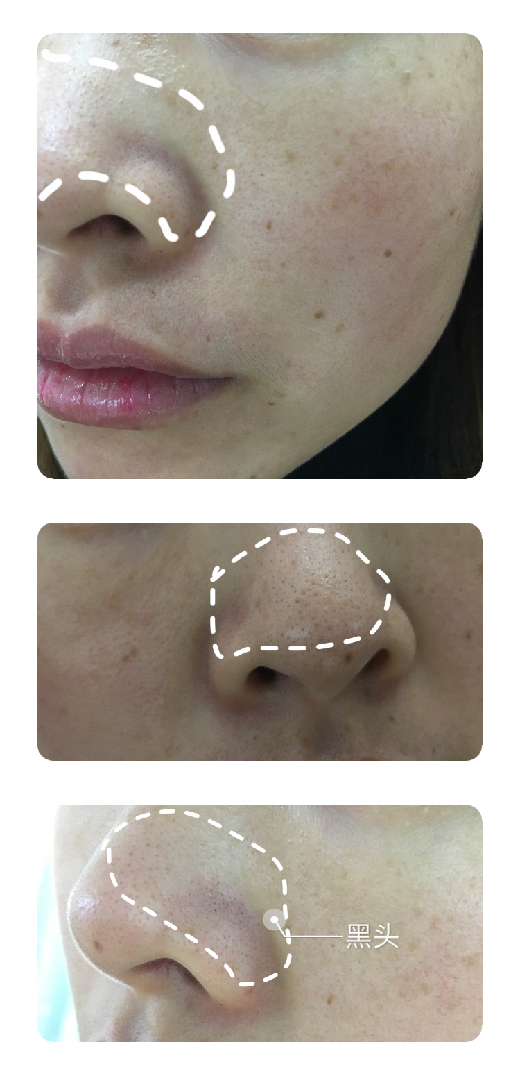 鼻头黑头毛孔粗大怎么办,鼻头黑头怎么手动处理