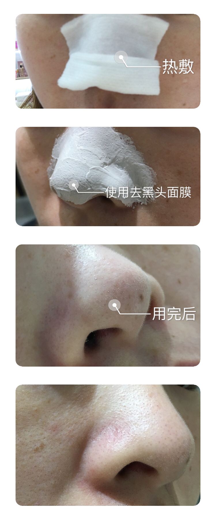 鼻头黑头毛孔粗大怎么办,鼻头黑头怎么手动处理