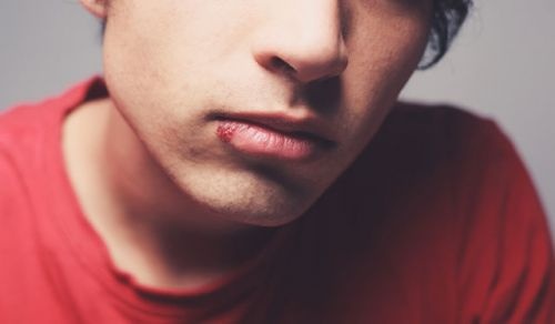 莫匹罗星软膏可以治疗嘴角起泡吗,嘴角经常上火起泡什么原因