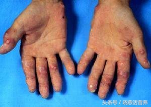 痛风病人能吃海藻类食物有哪些,海带痛风能吃吗嘌呤高吗