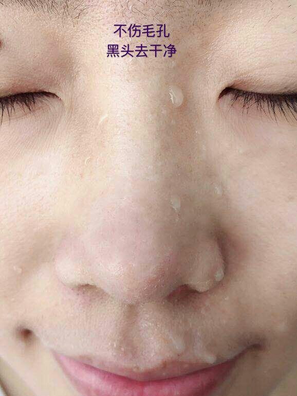 小孩黑头怎么去除最有效的方法,脸上黑头粉刺毛孔粗大怎么去除