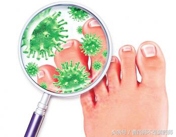 脚气顽固反复老李教你两招,脚气反复10多年手把手教您解决