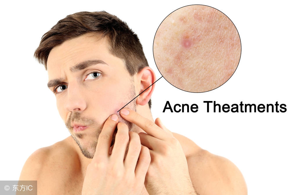 下巴起闭合粉刺怎么处理,下巴长粉刺该怎么处理