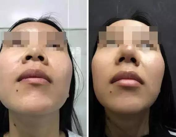隆鼻之后第三天老是流黄水出来,隆鼻一个月后越来越丑