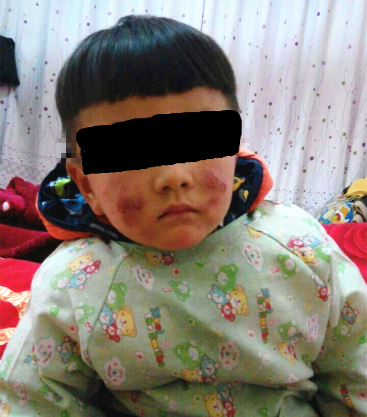 宝宝干性湿疹皮肤渗出溃烂,婴儿湿疹用药后三天又反复了