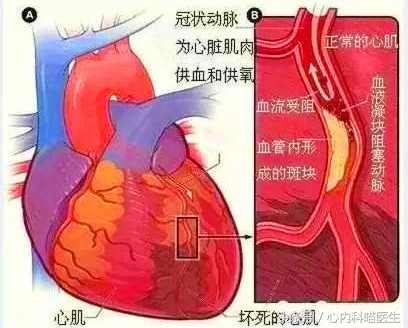 长期药物治疗可以减轻冠状动脉狭窄、减少心绞痛和心梗发生