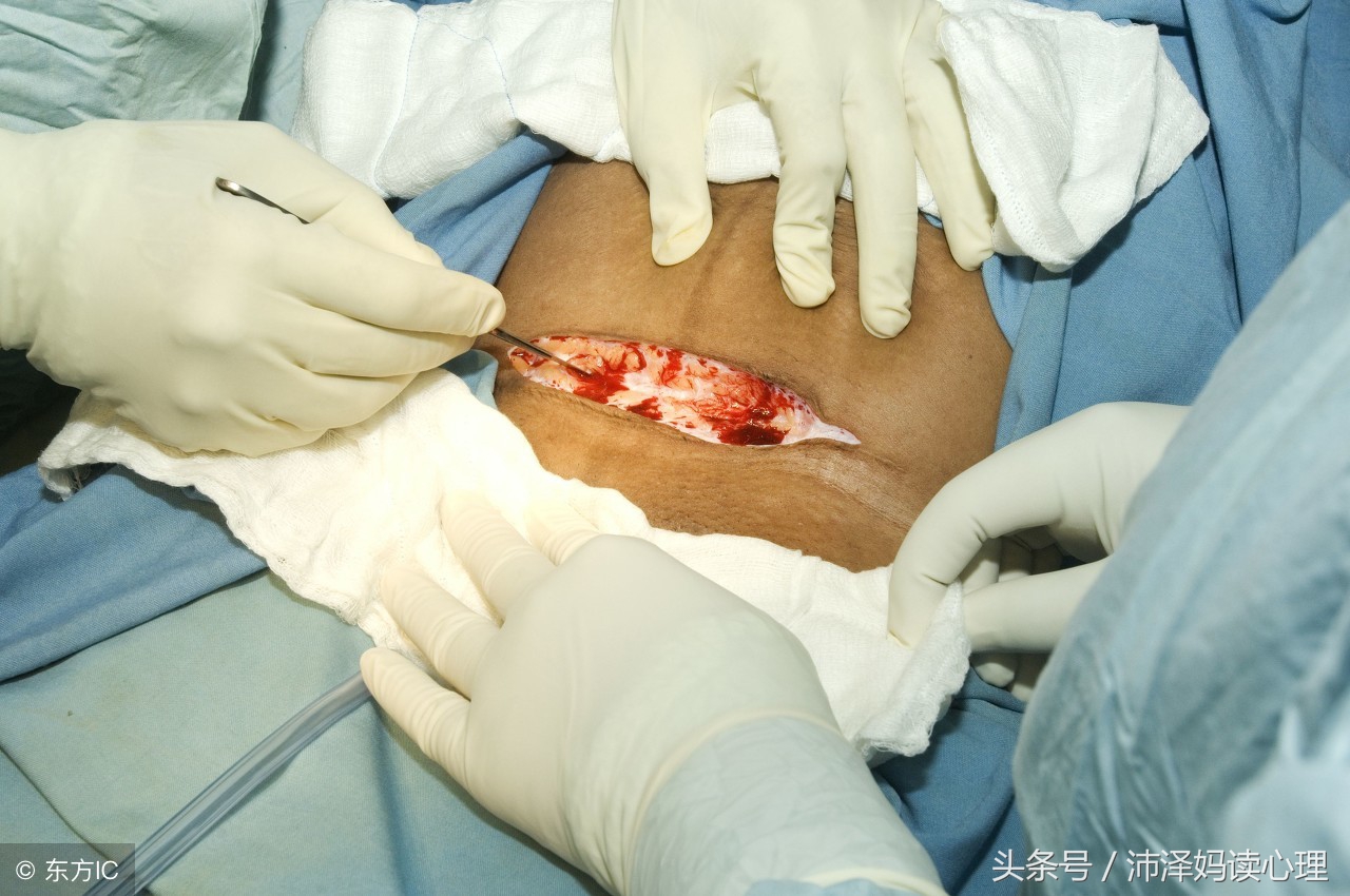 剖宫产第二次怀孕也要剖宫产吗,剖腹产后宝妈最怕什么