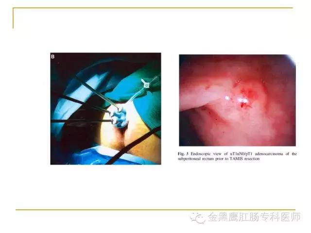 直肠腺瘤绒毛状转变成癌的几率,直肠绒毛腺瘤怎样治疗