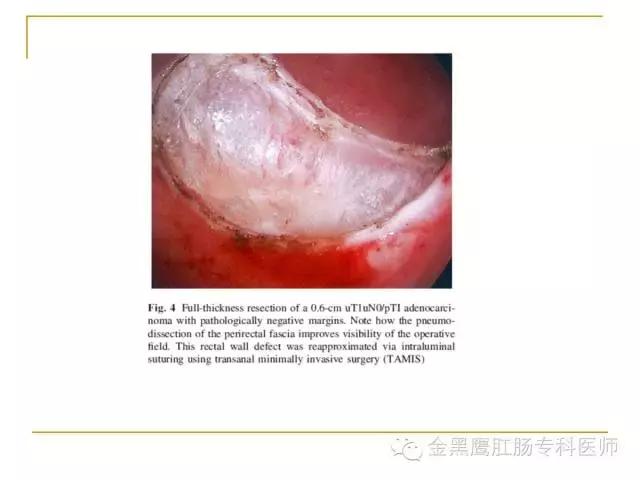 直肠腺瘤绒毛状转变成癌的几率,直肠绒毛腺瘤怎样治疗