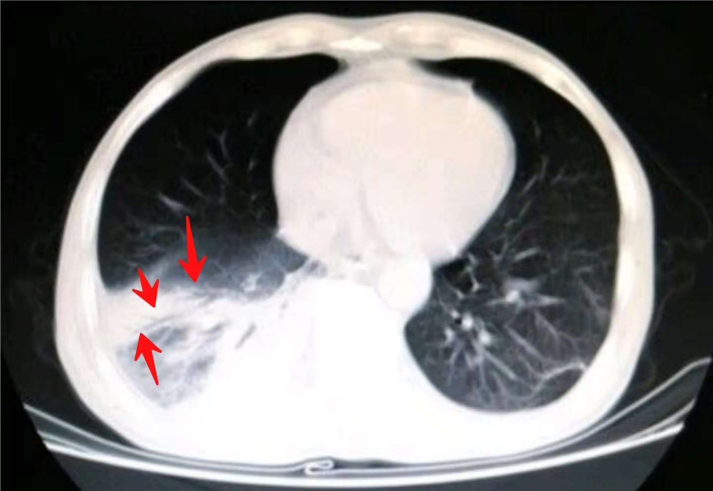 咳嗽几个月都没好会得肺癌吗,29岁女孩咳嗽一周肺癌