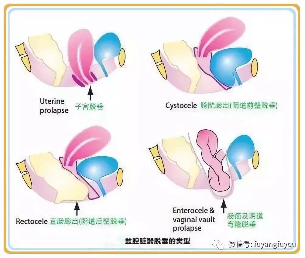 生完孩子漏尿漏大便是怎么回事,生完宝宝尿频漏尿怎么回事