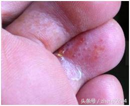 晚间脚气知识科普,科普脚气小知识