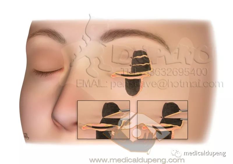 医学插画插图,医学插画sci