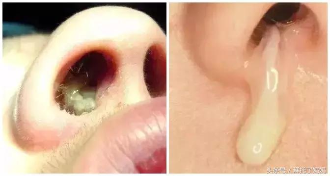清鼻涕和黄鼻涕怎么治,清鼻涕黄苔