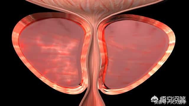 良性前列腺增生怎么治疗好得快,良性前列腺增生怎么治疗最有效