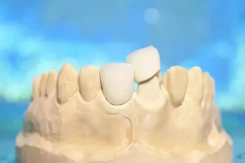 烤瓷牙与全瓷牙价格相差近十倍?究竟贵在哪?