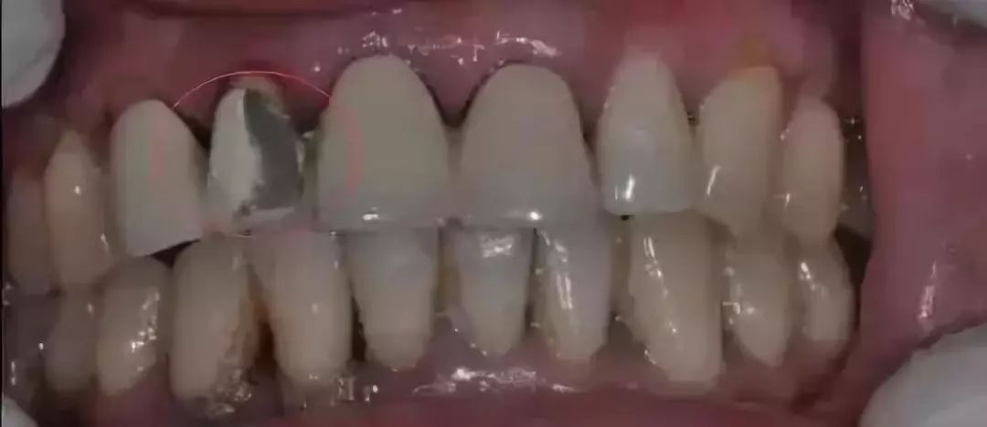 烤瓷牙与全瓷牙价格相差多少,烤瓷牙和全瓷牙价格差多少钱