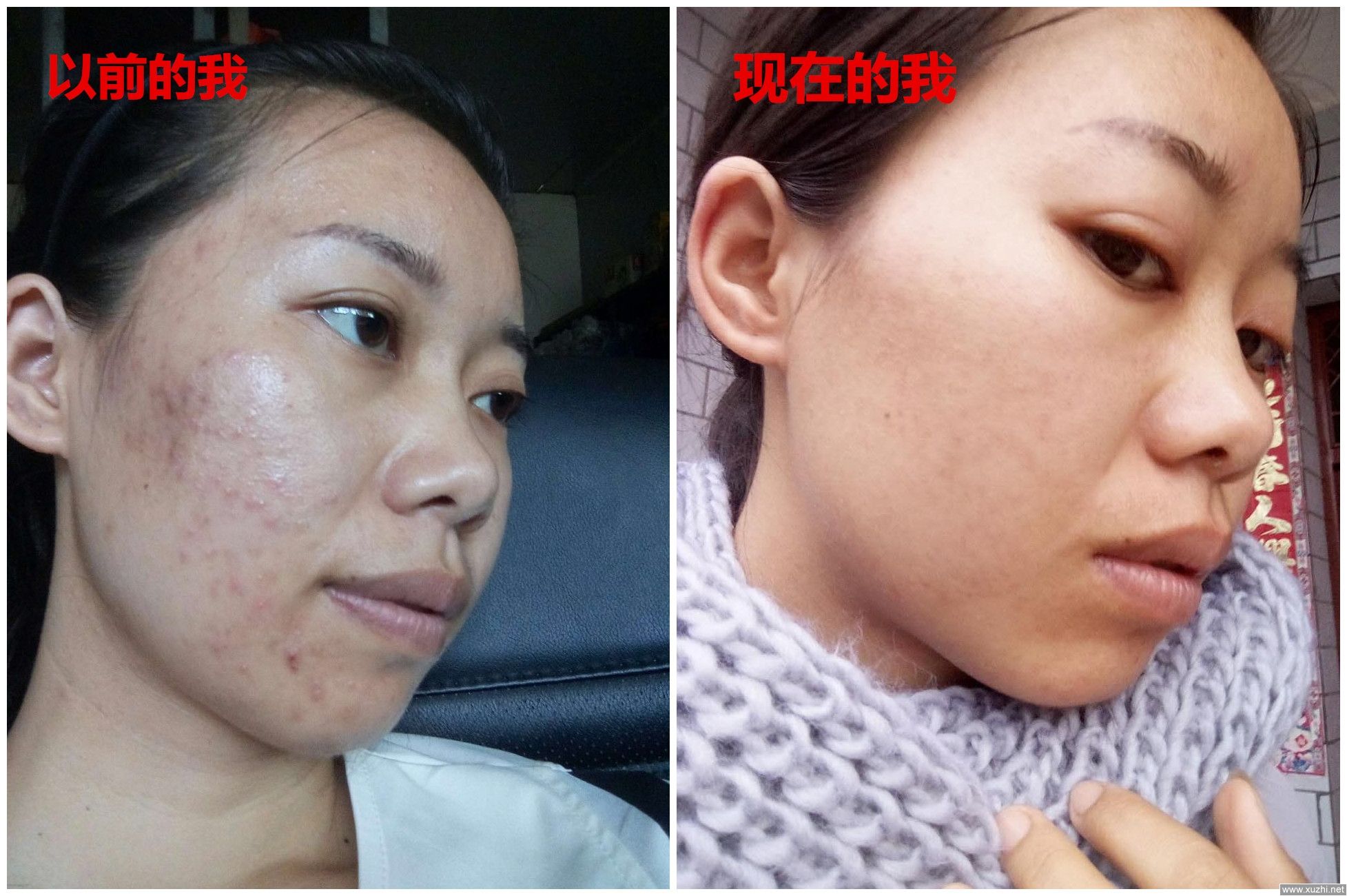 悄然流行的祛痘神器：珂玥（coco）老师的“3×1定期跟踪疗法”