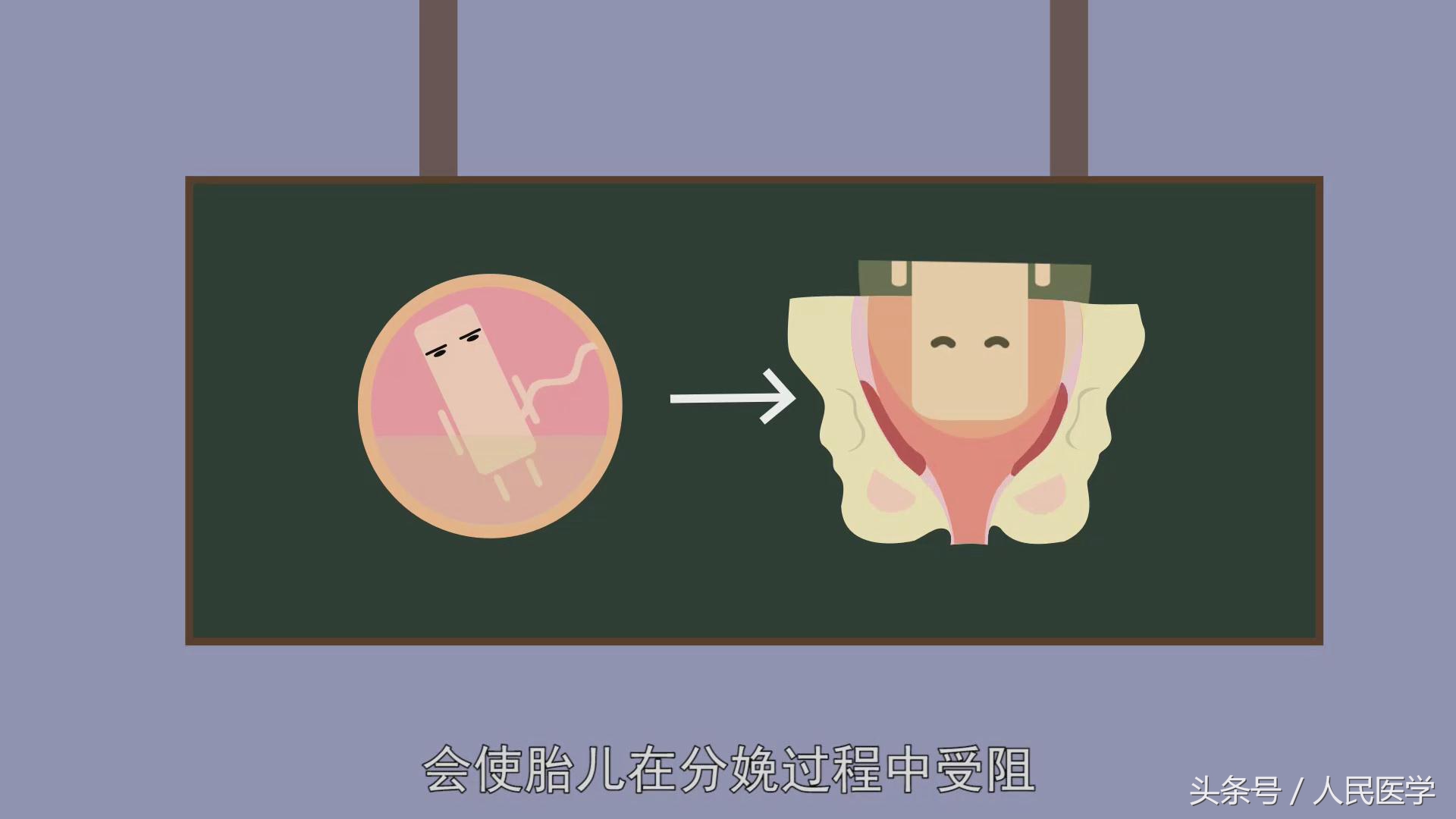 怀孕足月没反应直接剖腹产吗,孕期多少天妊娠反应可以消失