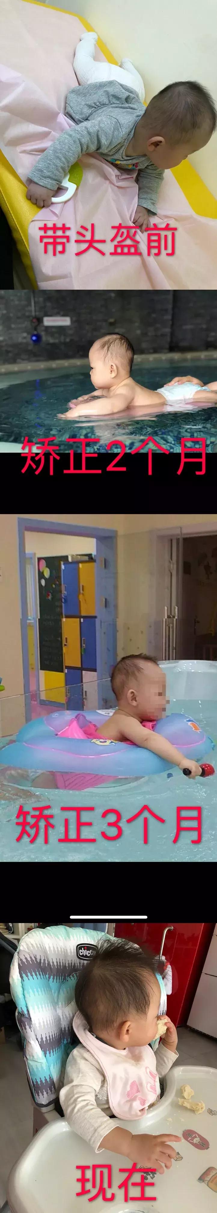 宝宝偏头斜头严重长大了会好吗,宝宝头偏脸歪有什么办法吗