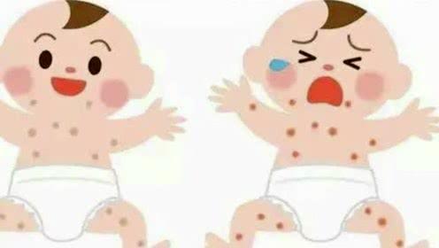 婴儿湿疹脱屑干痒怎么办,宝宝皮肤干燥湿疹擦什么