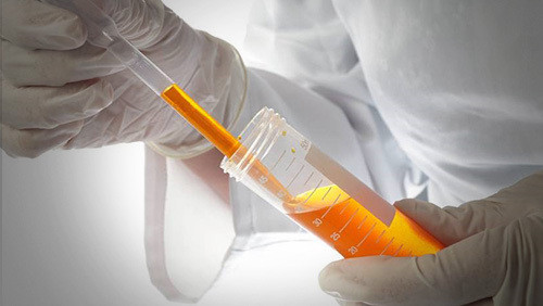 引起血尿的原因一定是肾有问题吗,引起血尿的原因有哪些