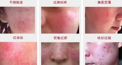激素脸怎么根治最有效,激素脸的有效根治方法