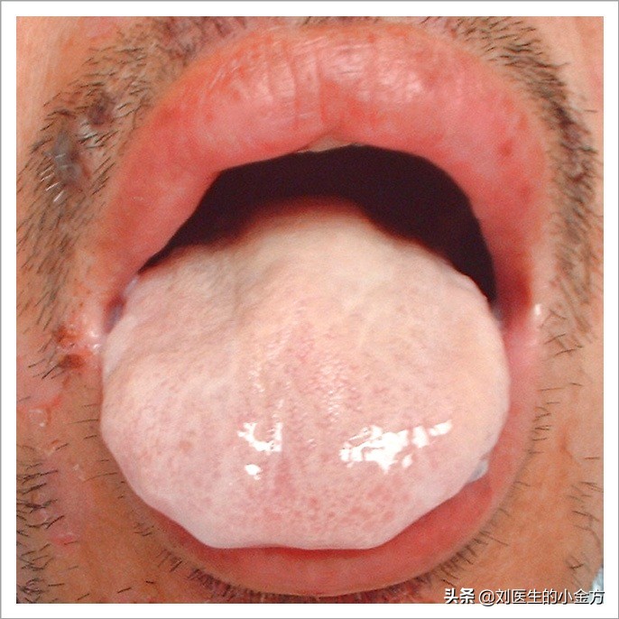 中医舌诊图解100例,中医舌诊图与舌诊口诀
