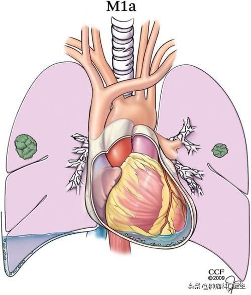 肺癌胸水消失了但气喘严重,肺癌晚期每天抽胸水能活多久