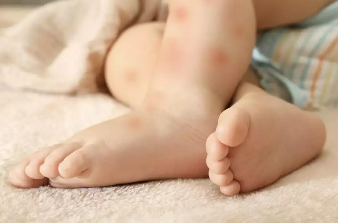 孕妇被蚊子咬了怎么止痒消肿,蚊子咬了止痒消肿最快的办法