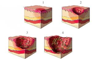 老年人腿粉碎性骨折手术要多少钱,老年人髋骨骨折后一年死亡率