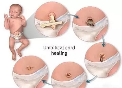 出生20天宝宝肚脐出血是怎么回事,新生儿脐带脱落后肚脐出血的护理