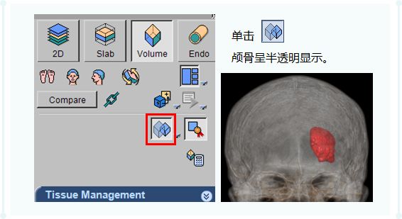 ct后处理重建技术,ct后处理技巧