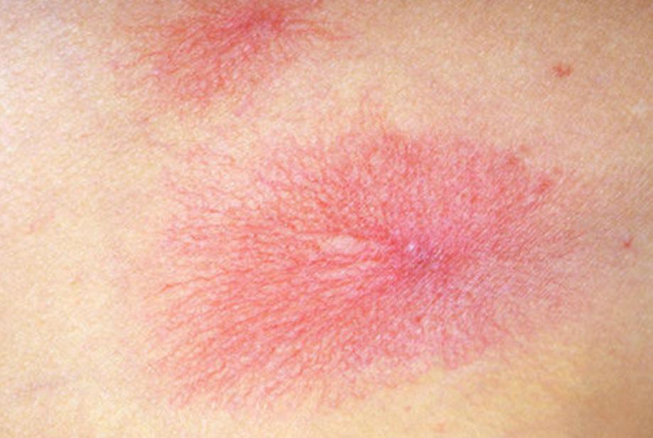 皮肤上长红痣要当心是肝病的征兆,有肝病前胸后背会出现小点红痣