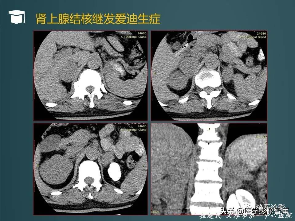 左侧肾上腺结节考虑腺瘤与增生,双侧肾上腺增生是什么原因造成的