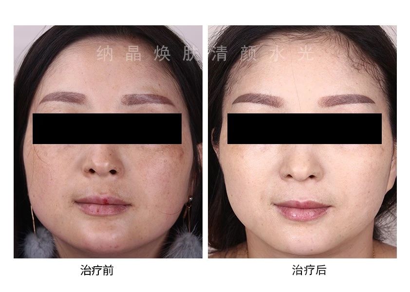 褐斑怎么治才能除根,根治面部黑褐斑的方法