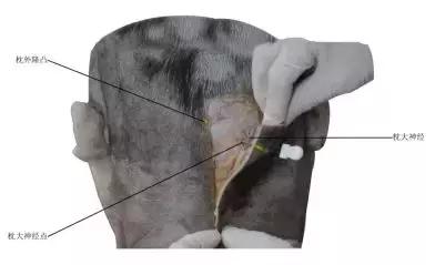 颈源性头痛中医治疗,颈源性头痛中药处方