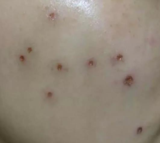 街上点痣10元可靠吗,路边点痣真的可靠吗