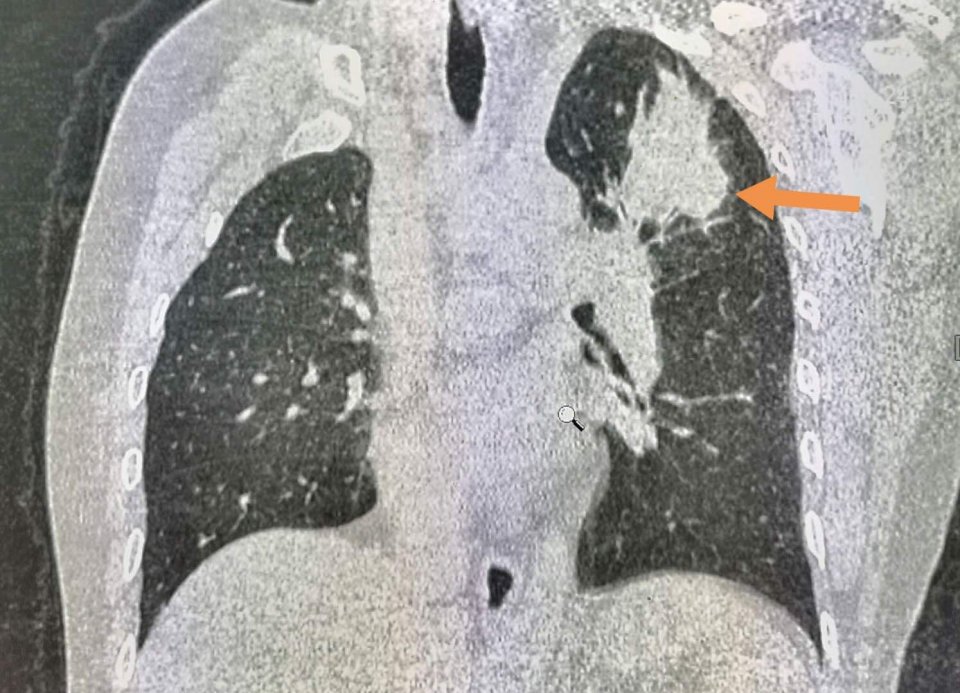 年年体检为啥查出癌症,每年正常体检能检查出肺癌吗