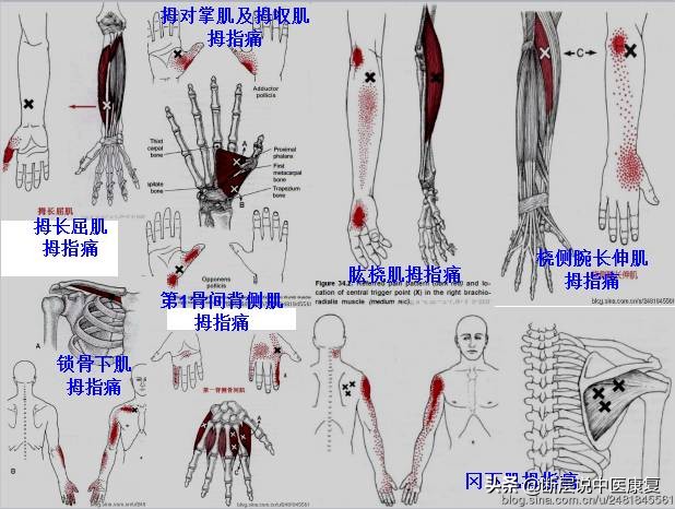激痛点挂图,激痛点疗法笔记